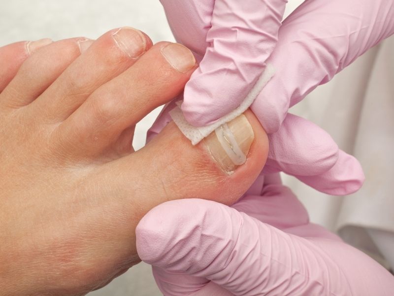 Ingrown Toenail Treatment in Singapore