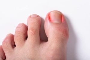 ingrown toenail red sore pain toe