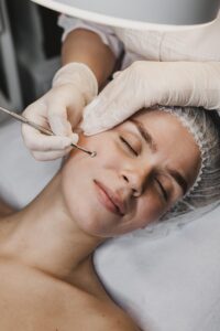 Acne Treatment in Singapore